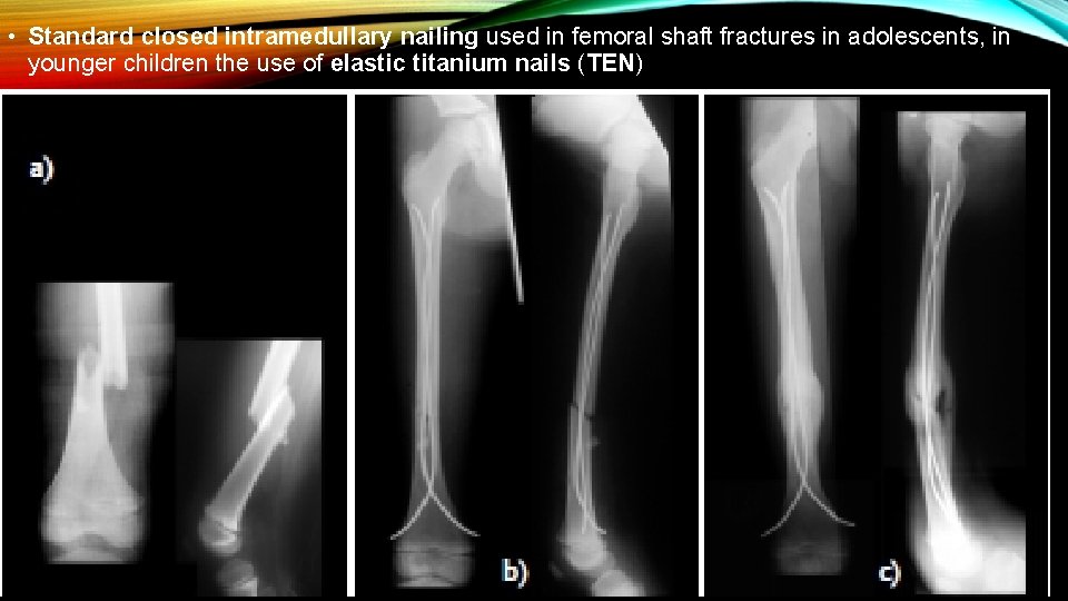 • Standard closed intramedullary nailing used in femoral shaft fractures in adolescents, in • Standard closed intramedullary nailing used in femoral shaft fractures in adolescents, in