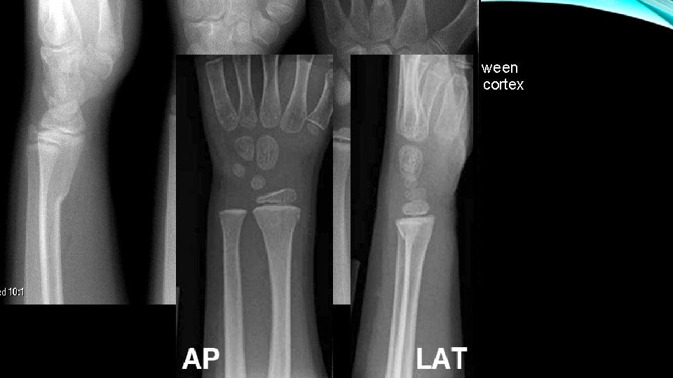a. Buckle (Torus) Fractures- most commonly occur at transition between metaphyseal woven bone and a. Buckle (Torus) Fractures- most commonly occur at transition between metaphyseal woven bone and