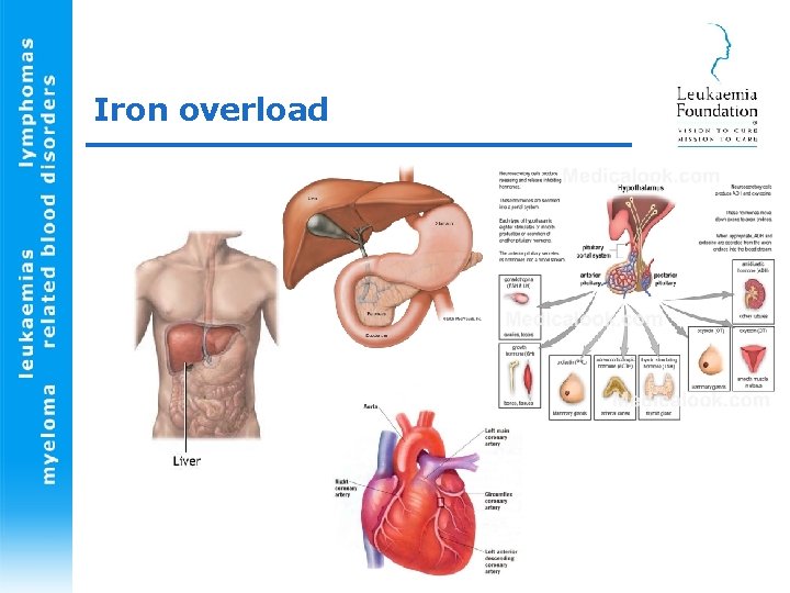 Iron overload 