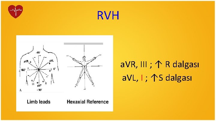 RVH a. VR, III ; ↑ R dalgası a. VL, I ; ↑S dalgası