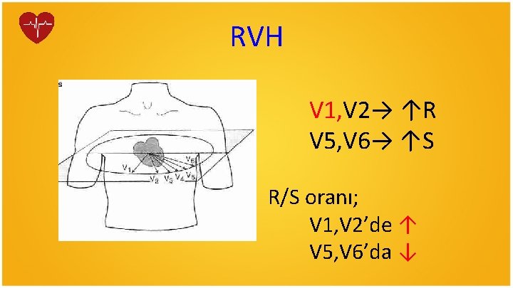 RVH V 1, V 2→ ↑R V 5, V 6→ ↑S R/S oranı; V