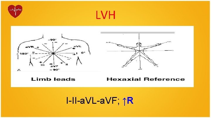 LVH I-II-a. VL-a. VF; ↑R 