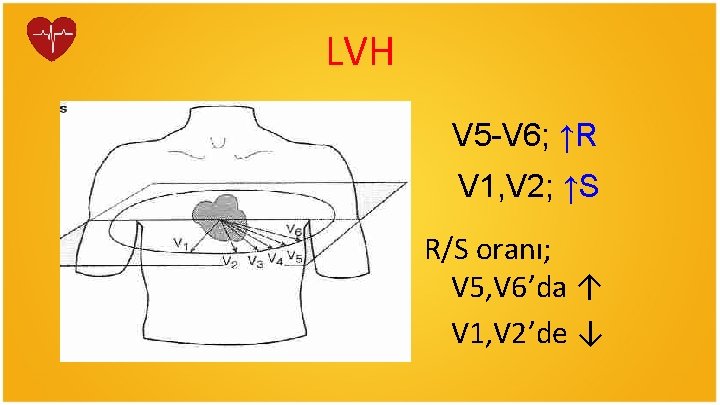 LVH V 5 -V 6; ↑R V 1, V 2; ↑S R/S oranı; V