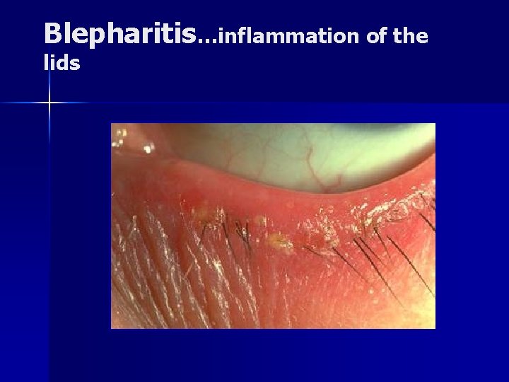 Blepharitis…inflammation of the lids 