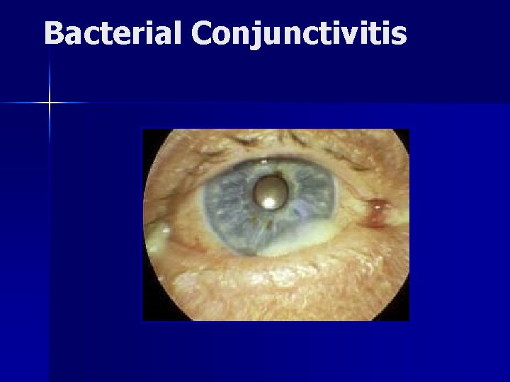 Bacterial Conjunctivitis 