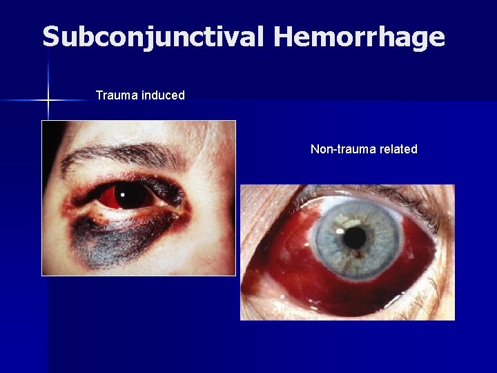 Subconjunctival Hemorrhage Trauma induced Non-trauma related 