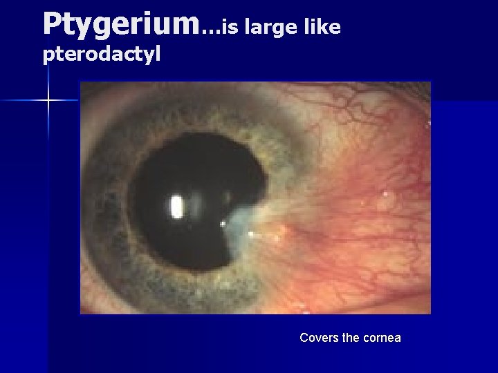 Ptygerium…is large like pterodactyl Covers the cornea 