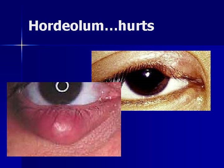 Hordeolum…hurts 