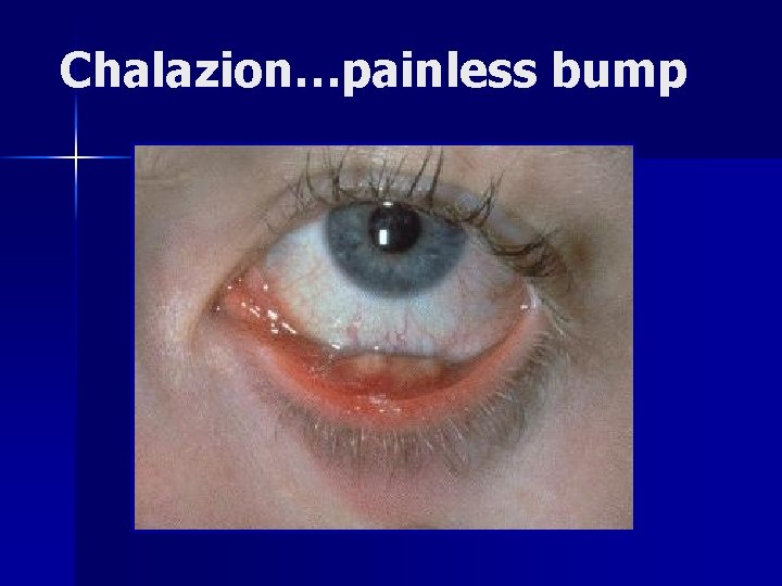 Chalazion…painless bump 