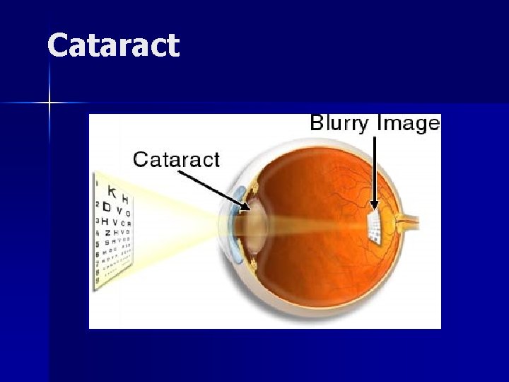 Cataract 