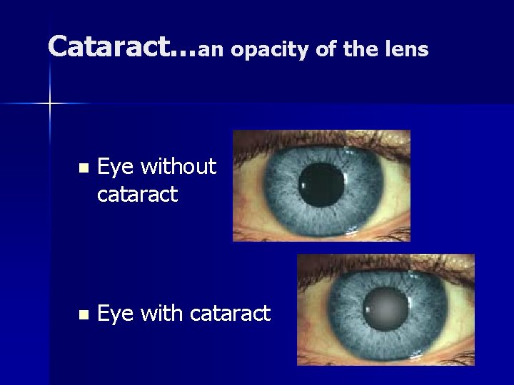 Cataract…an opacity of the lens n Eye without cataract n Eye with cataract 