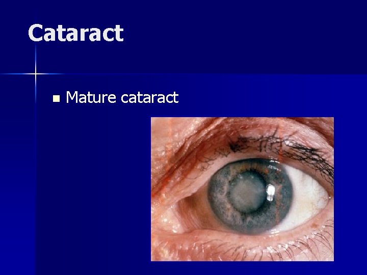 Cataract n Mature cataract 