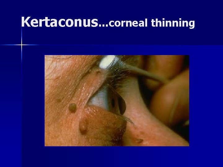 Kertaconus…corneal thinning 