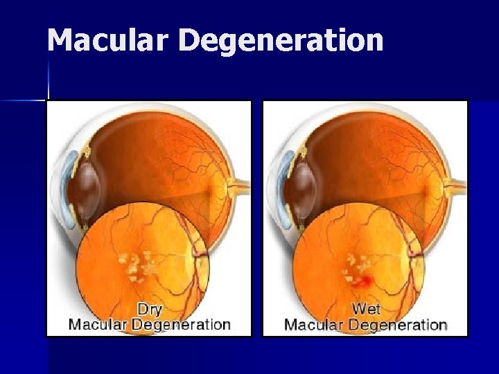 Macular Degeneration 