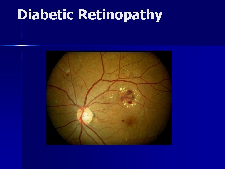 Diabetic Retinopathy 