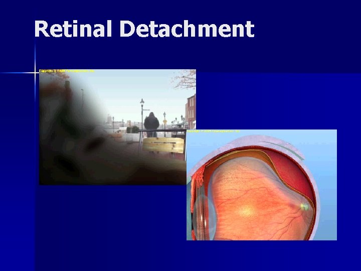 Retinal Detachment 