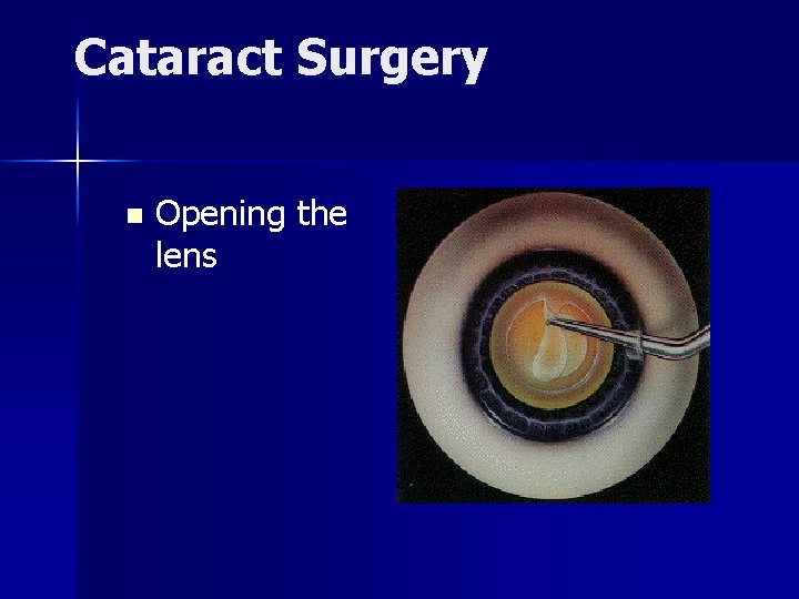 Cataract Surgery n Opening the lens 