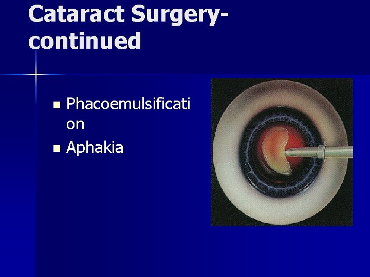 Cataract Surgerycontinued Phacoemulsificati on n Aphakia n 