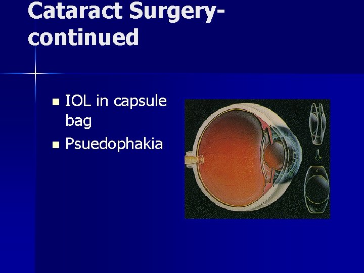 Cataract Surgerycontinued IOL in capsule bag n Psuedophakia n 