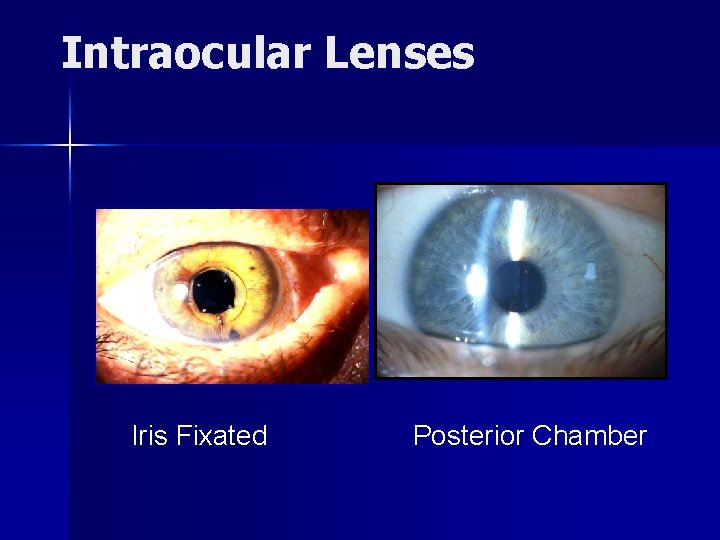 Intraocular Lenses Iris Fixated Posterior Chamber 