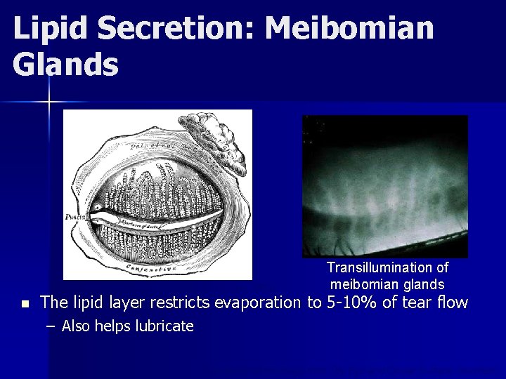 Lipid Secretion: Meibomian Glands (WC Posey, Diseases of the Eye, 1902) n Transillumination of