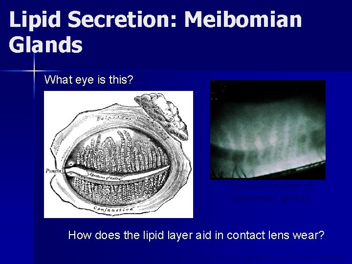 Lipid Secretion: Meibomian Glands What eye is this? Transillumination of meibomian glands (WC Posey,