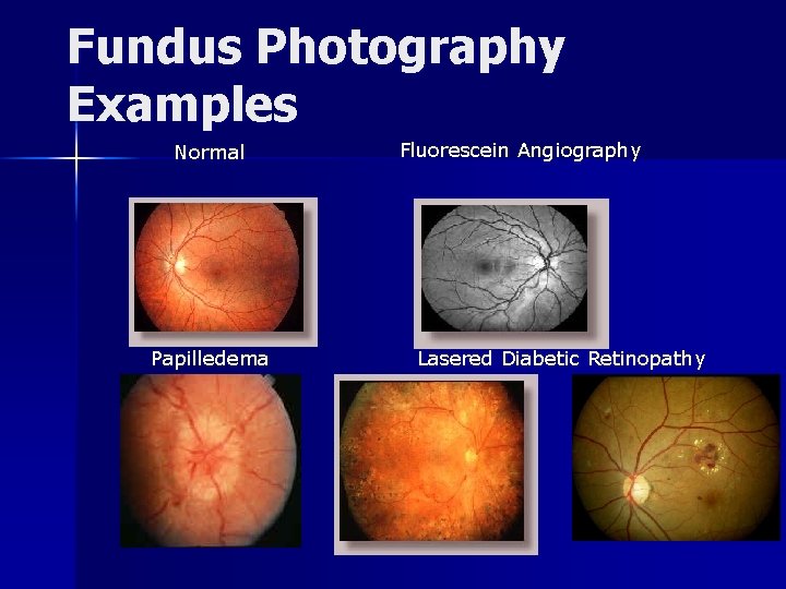 Fundus Photography Examples Normal Papilledema Fluorescein Angiography Lasered Diabetic Retinopathy 