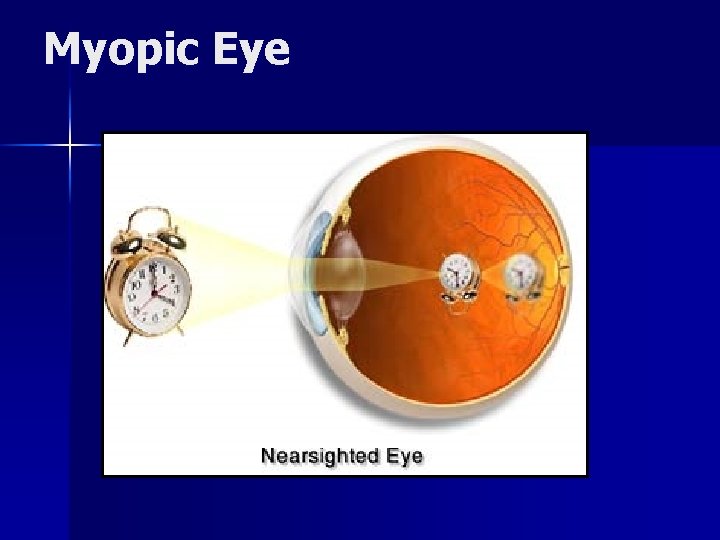 Myopic Eye 