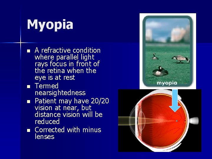 Myopia n n A refractive condition where parallel light rays focus in front of