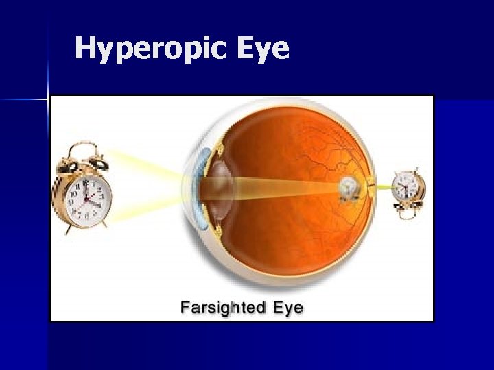 Hyperopic Eye 