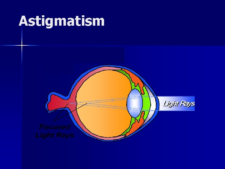 Astigmatism 