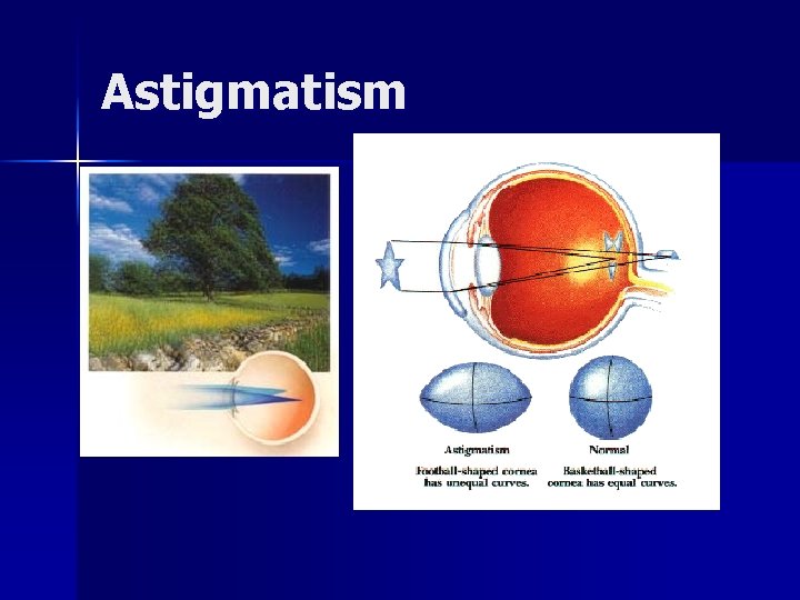 Astigmatism 