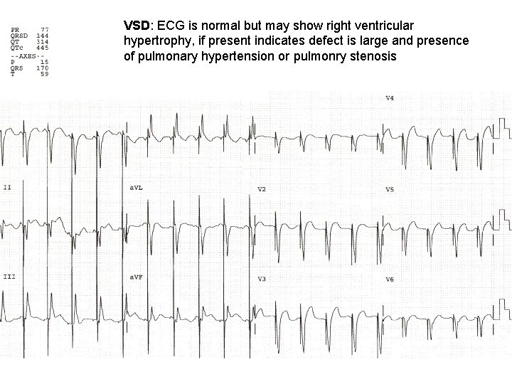 VSD: ECG is normal but may show right ventricular hypertrophy, if present indicates defect