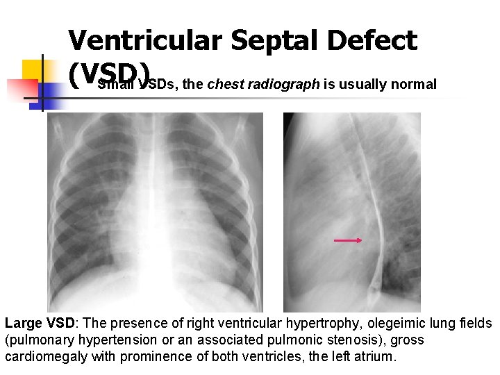 Ventricular Septal Defect (VSD) Small VSDs, the chest radiograph is usually normal Large VSD: