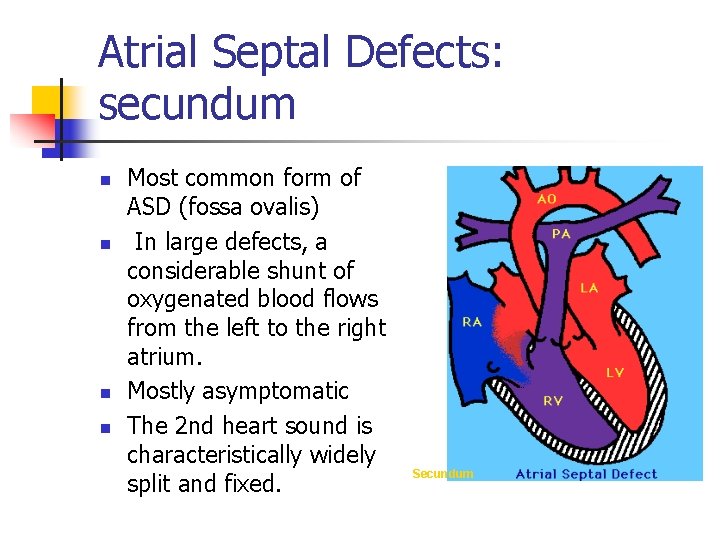 Atrial Septal Defects: secundum n n Most common form of ASD (fossa ovalis) In
