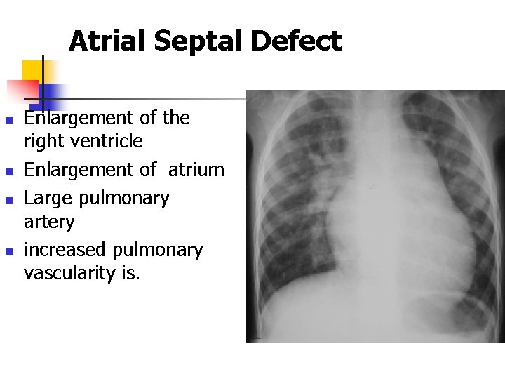 Atrial Septal Defect n n Enlargement of the right ventricle Enlargement of atrium Large