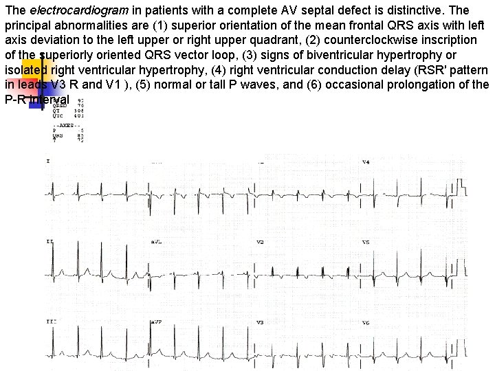 The electrocardiogram in patients with a complete AV septal defect is distinctive. The principal