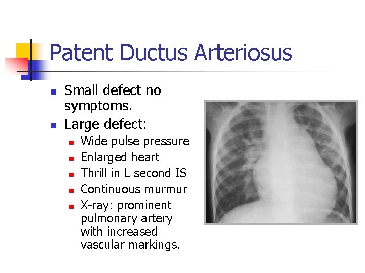 Patent Ductus Arteriosus n n Small defect no symptoms. Large defect: n n n