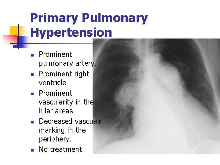 Primary Pulmonary Hypertension n n Prominent pulmonary artery. Prominent right ventricle Prominent vascularity in