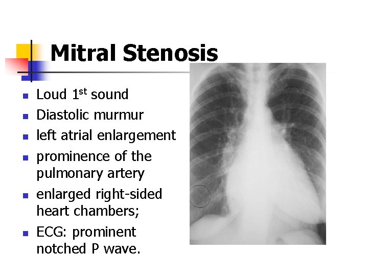 Mitral Stenosis n n n Loud 1 st sound Diastolic murmur left atrial enlargement