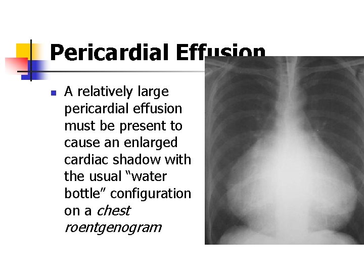 Pericardial Effusion n A relatively large pericardial effusion must be present to cause an