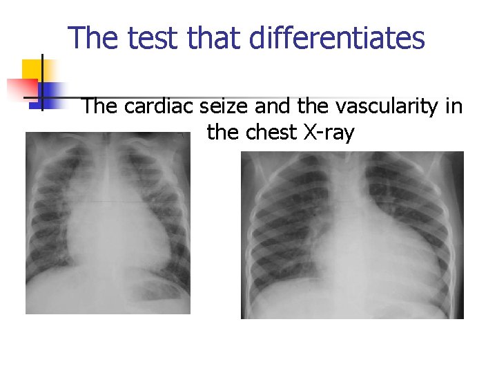 The test that differentiates The cardiac seize and the vascularity in the chest X-ray