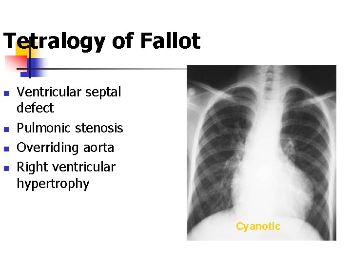 Tetralogy of Fallot n n Ventricular septal defect Pulmonic stenosis Overriding aorta Right ventricular