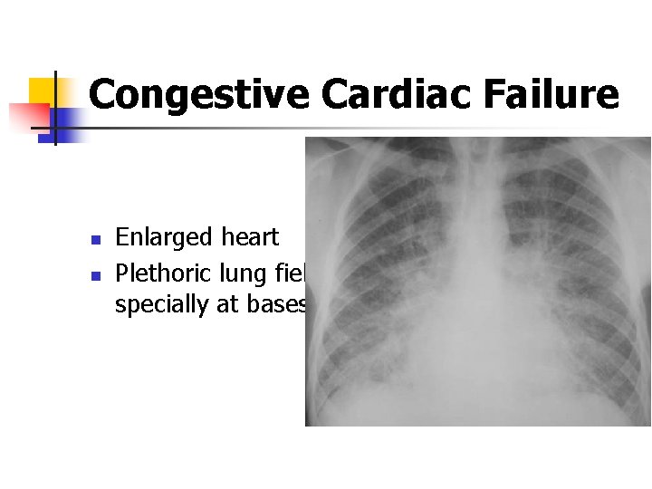 Congestive Cardiac Failure n n Enlarged heart Plethoric lung fields specially at bases 
