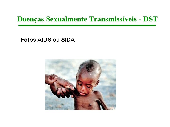 Doenças Sexualmente Transmissíveis - DST Fotos AIDS ou SIDA 