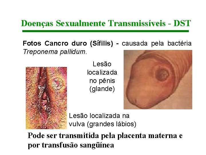 Doenças Sexualmente Transmissíveis - DST Fotos Cancro duro (Sífilis) - causada pela bactéria Treponema