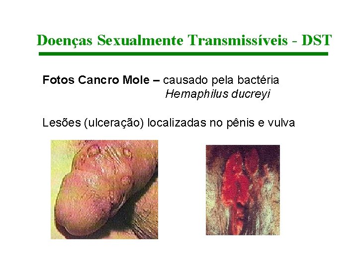 Doenças Sexualmente Transmissíveis - DST Fotos Cancro Mole – causado pela bactéria Hemaphilus ducreyi