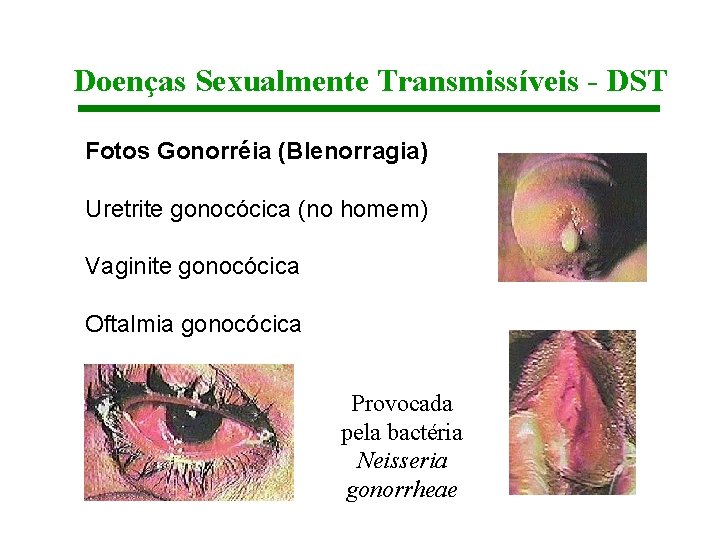 Doenças Sexualmente Transmissíveis - DST Fotos Gonorréia (Blenorragia) Uretrite gonocócica (no homem) Vaginite gonocócica