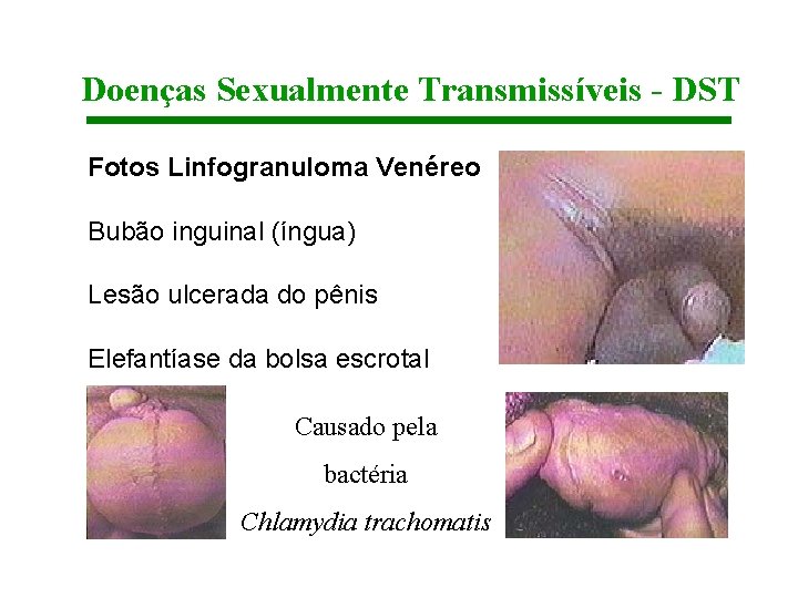 Doenças Sexualmente Transmissíveis - DST Fotos Linfogranuloma Venéreo Bubão inguinal (íngua) Lesão ulcerada do