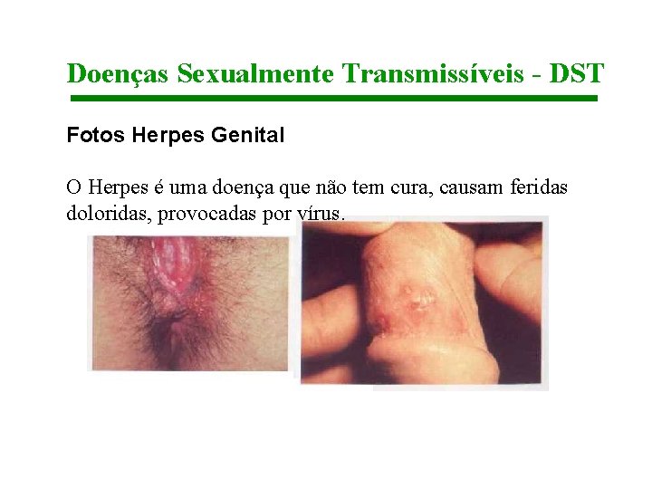Doenças Sexualmente Transmissíveis - DST Fotos Herpes Genital O Herpes é uma doença que